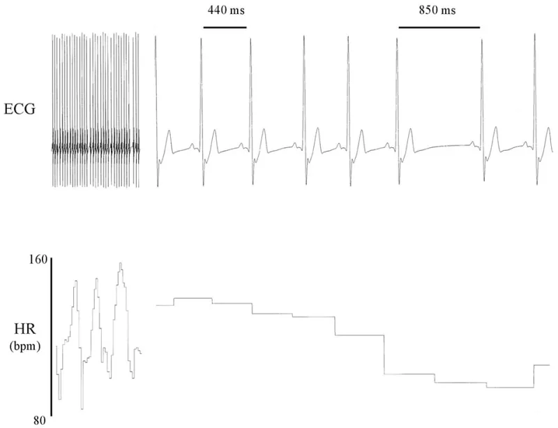 The Recovery Advantage Hidden in Your Heartbeat: What HRV Data Reveals About Who Heals Fastest